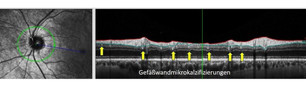 Gefäßwandmikrokalzifizierung